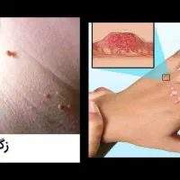 محلول درمان زگیل و زگیل تناسلی|آرایشی، بهداشتی، درمانی|میناب, |دیوار