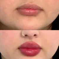 ژل‌بوتاکس‌مزو