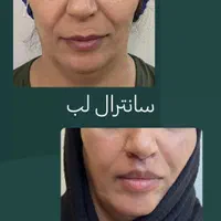 بلفاروپلاستی (پف چشم )، سانترال لب در رشدیه|خدمات آرایشگری و زیبایی|تبریز, |دیوار