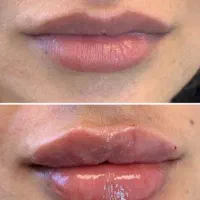 تخفیف ویژه روی کلیه کارهای زیبایی فیلر و بوتاکس|خدمات آرایشگری و زیبایی|شیراز, تاچارا|دیوار