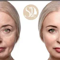 لیزر اندولیفت جهت جوانسازی در مطب متخصص پوست و مو