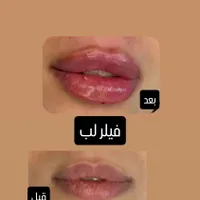 تزریق ژل با قیمت مناسب وبا کیفیت|خدمات آرایشگری و زیبایی|برازجان, |دیوار