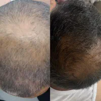 تونیک رشد مو