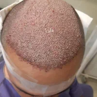 کاشت مو تخصصی دلربا|خدمات آرایشگری و زیبایی|حمیدیه, |دیوار