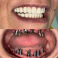 ایمپلنت دندان کره ای فقط ۵ میلیون|خدمات آرایشگری و زیبایی|تهران, شادمان|دیوار