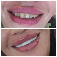 کامپوزیت زیبایی دندان درکلینیک دندانپزشکی|خدمات آرایشگری و زیبایی|یاسوج, |دیوار