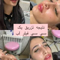 مطب بلفارو فیلر غبغب بوتاکس لیزر