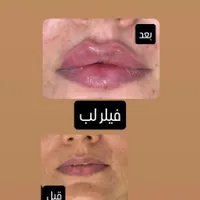 تزریق ژل با قیمت مناسب وبا کیفیت|خدمات آرایشگری و زیبایی|برازجان, |دیوار