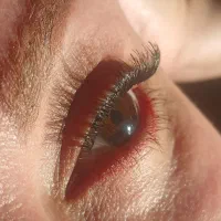 کاشت مژه هیدن