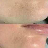 فیشال تخصصی خانم ها واقایان تحت نظر پزشک|خدمات آرایشگری و زیبایی|زاهدان, |دیوار