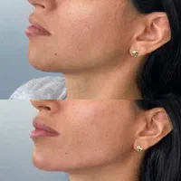 تزریق ژل و بوتاکس جشنواره عید|خدمات آرایشگری و زیبایی|تهران, عبدل‌آباد|دیوار