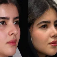 هزینه جراحی بینی درتهران۴۳میلیون/ویژه اسدآبادی ها