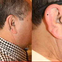 لیزر تخصصی ویژه آقایون