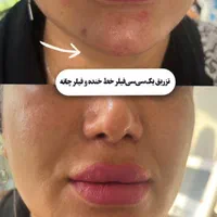 لیزر موهای زاید تزریق بوتاکس وژل  توسط پزشک|خدمات آرایشگری و زیبایی|تالش, هشتپر|دیوار