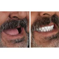 دندان مصنوعی جوان پسندطرح لمینیت اقساط چک و سفته