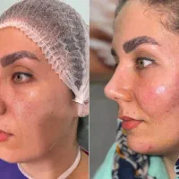 تخفیفات فیلربادی هر سی سی۲۵۰فیلربیکینی ۳۵سی سی۷۵۰۰