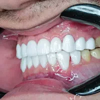 جشنواره کامپوزیت فقط از فکی ۳.۵ اقساطی،لمینیت،روکش