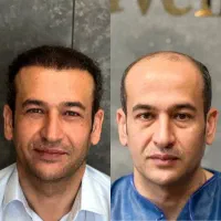 کاشت مو و ابرو|خدمات آرایشگری و زیبایی|بوشهر, |دیوار