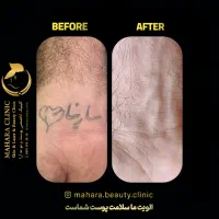 آف لیزر حذف تتو/لک پوست/پیلینگ کربن/روشنسازیDrمقدم|خدمات آرایشگری و زیبایی|مشهد, هفت تیر (آب و برق)|دیوار