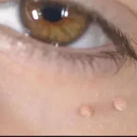 از بین برنده زگیل تناسلی درکنار از۱۵روزبهبودی کامل|خدمات آرایشگری و زیبایی|گرمسار, |دیوار