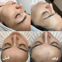 به چند نفر برای مدل پاکسازی پوست لازم دارم|خدمات آرایشگری و زیبایی|شاهین دژ, |دیوار