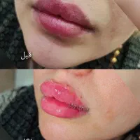 تزریق ژل بوتاکس چال گونه تتو پرسینگ مژه و اموزش|خدمات آرایشگری و زیبایی|اهواز, معین زاده|دیوار
