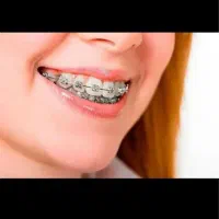 ارتودنسی پلاک متحرک برای کودکان