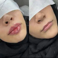 تخفیف ویژه ژل و بوتاکس فقط فول فیس فقط در ابادان