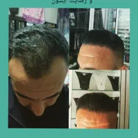 کاشت موی طبیعی‌‌ دوباره جذاب شو مثل روز اول