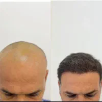 کاشت مو  به روش سوپر sutفقط با۲۵میلیون