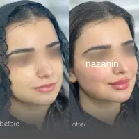 مطب گرگان عدالت ۱۳ بوتاکس ۸۰۰ ژل۱ تومان توسط پزشک|خدمات آرایشگری و زیبایی|گرگان, |دیوار