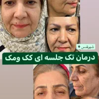 درمان کک ومک/درمان لک/درمان جوش/ردبخیه/اسکار