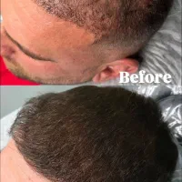 میکرو سر پرپشت کردن مو به صورت حرفه‌ای و تظمینی