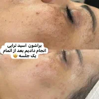 فیشیال پاکسازی حرفه ای با جدید ترین متد روز دنیا|خدمات آرایشگری و زیبایی|اهواز, کیانپارس |دیوار