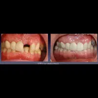 خدمات دندان بریچ frc جایگزین ایمپلنت|خدمات آرایشگری و زیبایی|اهواز, کیانپارس |دیوار