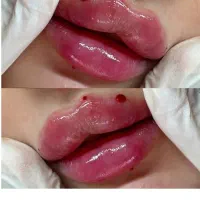 تزریق ژل و بوتاکس