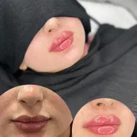 ژل و بوتاکس|خدمات آرایشگری و زیبایی|شوشتر, |دیوار