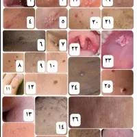 بهبود زگیل و تبخال|آرایشی، بهداشتی، درمانی|شیراز, دروازه اصفهان|دیوار