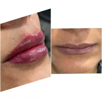 تزریق ژل بوتاکس فیلر گونه چونه لب