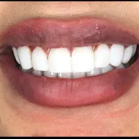 کامپوزیت دندان جشنواره|خدمات آرایشگری و زیبایی|تهران, فردوسی|دیوار