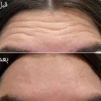 ژل بوتاکس آموزش تخصصی در مطب|خدمات آرایشگری و زیبایی|اصفهان, شهرک کاوه|دیوار