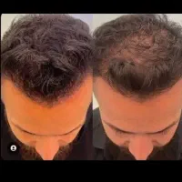 اینبار بدون کاشت  درستش کن