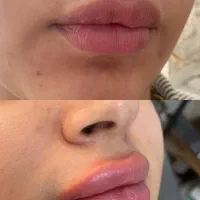 تخفیف۵۰٪ بوتاکس و فیلر (فقط یک هفته)|خدمات آرایشگری و زیبایی|ری, شهرری|دیوار