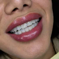 ونیر زیبایی کامپوزیت دندان