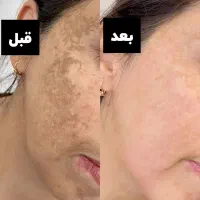 کرم ضد لک گیاهی وی ای پی|آرایشی، بهداشتی، درمانی|ایلام, |دیوار