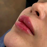 تزریق ژل و بوتاکس با بروزترین تکنیک ها