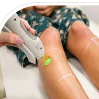 دستگاه لیزر شاتی کندلا2025