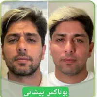 تخفیف کلینیک ژل بوتاکس نخ|خدمات آرایشگری و زیبایی|یاسوج, |دیوار
