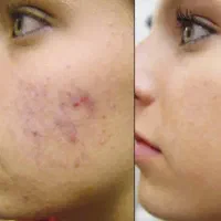 آموزش وخدمات پی آرپی وفیشال ومزوتراپی|خدمات زیبایی و سلامت|کرج, گلشهر|دیوار