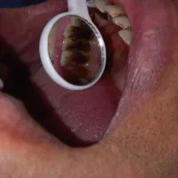 جرمگیری تخصصی دندان بدون خونریزی